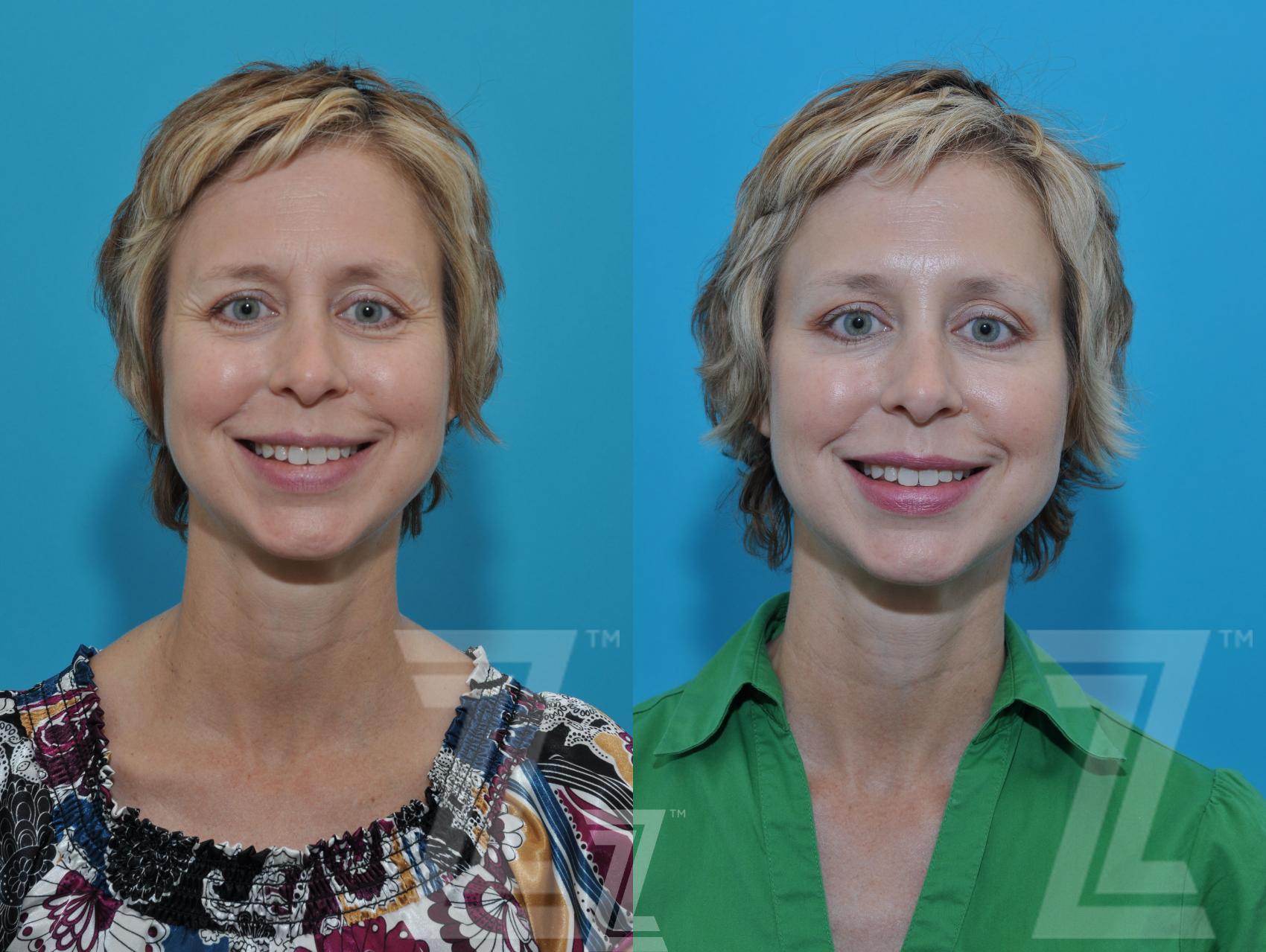 BOTOX® Cosmetic Before & After Photo | Austin, TX | The Piazza Center for Plastic Surgery & Advanced Skin Care