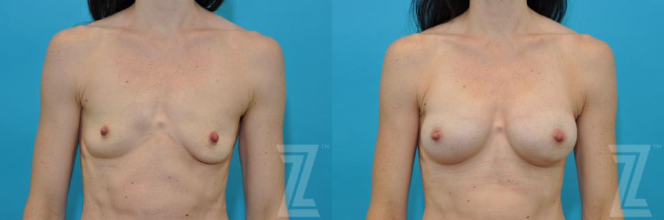 Breast Augmentation Before & After Photo | Austin, TX | The Piazza Center for Plastic Surgery & Advanced Skin Care