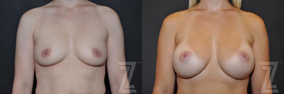 Breast Augmentation Before & After Photo | Austin, TX | The Piazza Center for Plastic Surgery & Advanced Skin Care