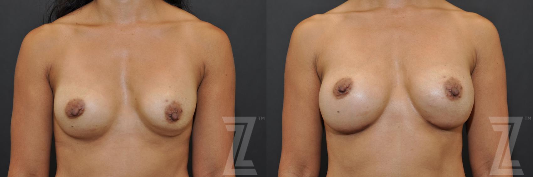 Breast Augmentation Revision Before & After Photo | Austin, TX | The Piazza Center for Plastic Surgery & Advanced Skin Care