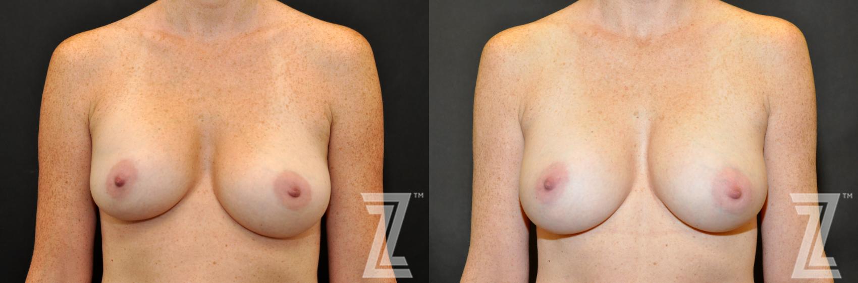 Breast Augmentation Revision Before & After Photo | Austin, TX | The Piazza Center for Plastic Surgery & Advanced Skin Care