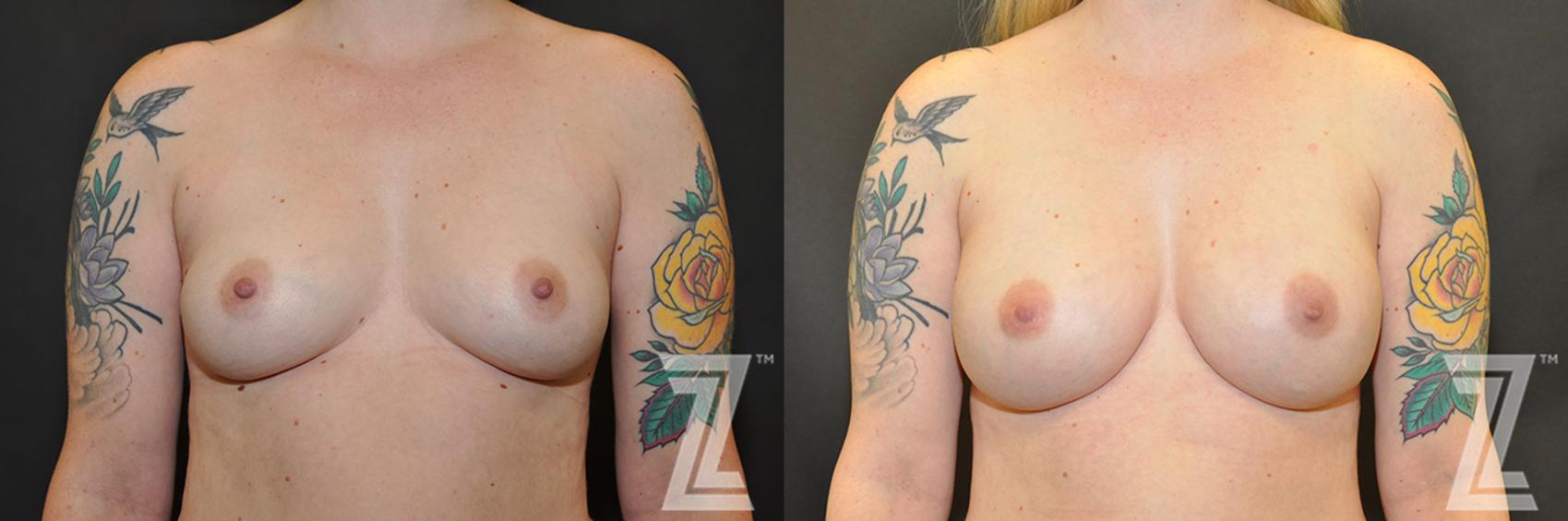 Breast Reconstruction Before & After Photo | Austin, TX | The Piazza Center for Plastic Surgery & Advanced Skin Care