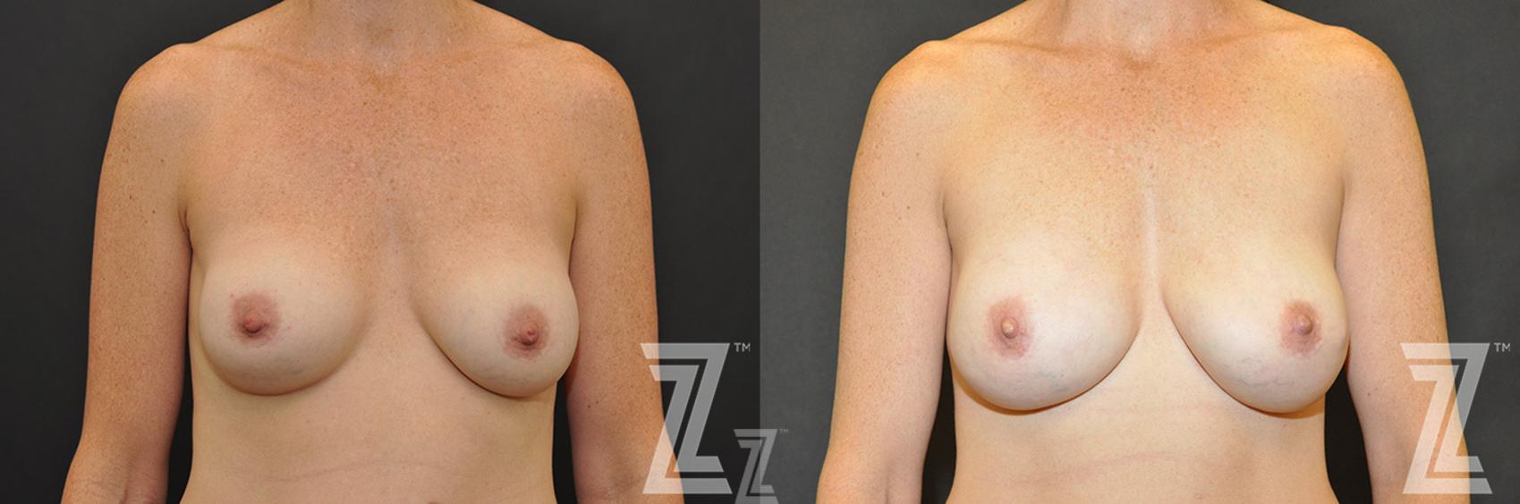 Breast Reconstruction Before & After Photo | Austin, TX | The Piazza Center for Plastic Surgery & Advanced Skin Care