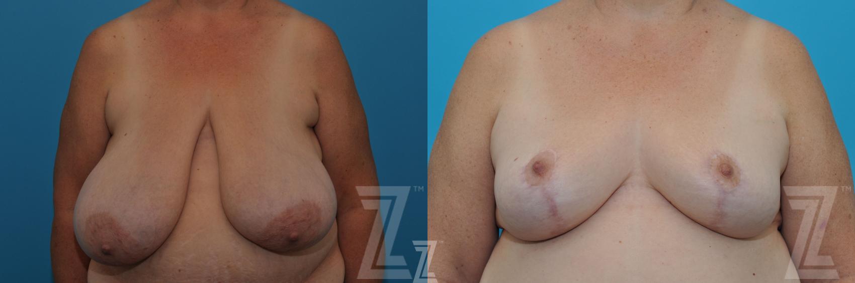 Breast Reduction Before & After Photo | Austin, TX | The Piazza Center for Plastic Surgery & Advanced Skin Care