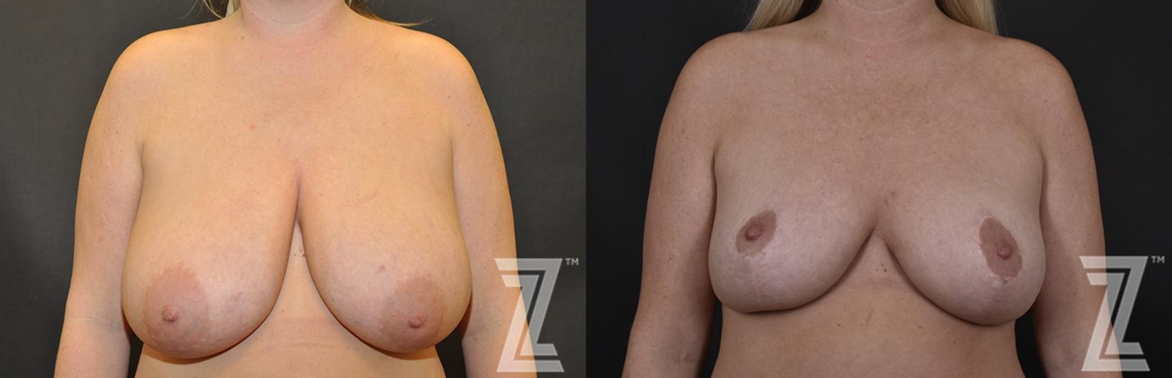 Breast Lift Before & After Photo | Austin, TX | The Piazza Center for Plastic Surgery & Advanced Skin Care