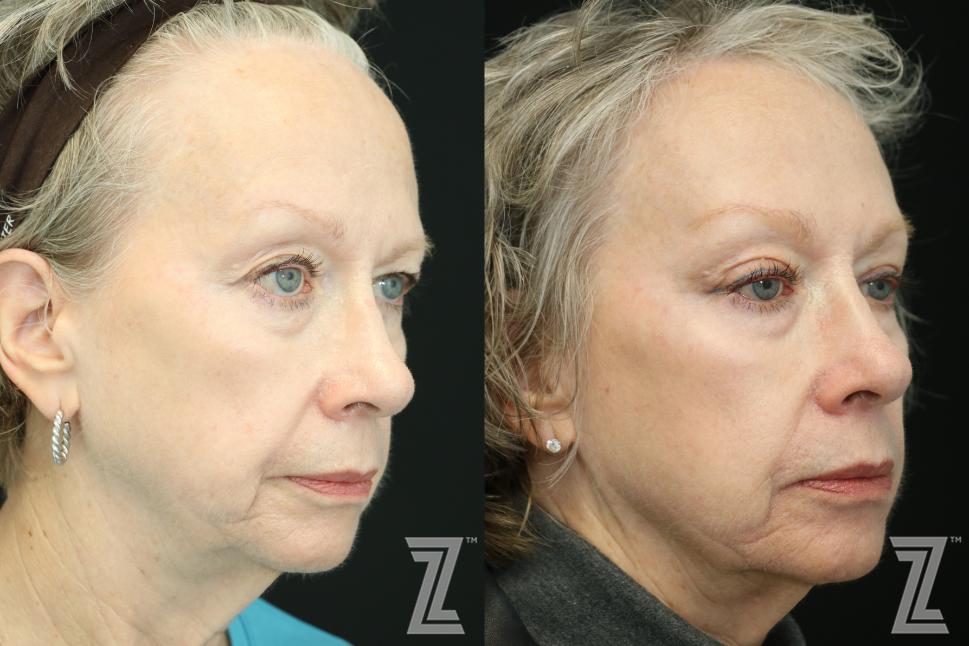 Brow Lift Before & After Photo | Austin, TX | The Piazza Center for Plastic Surgery & Advanced Skin Care