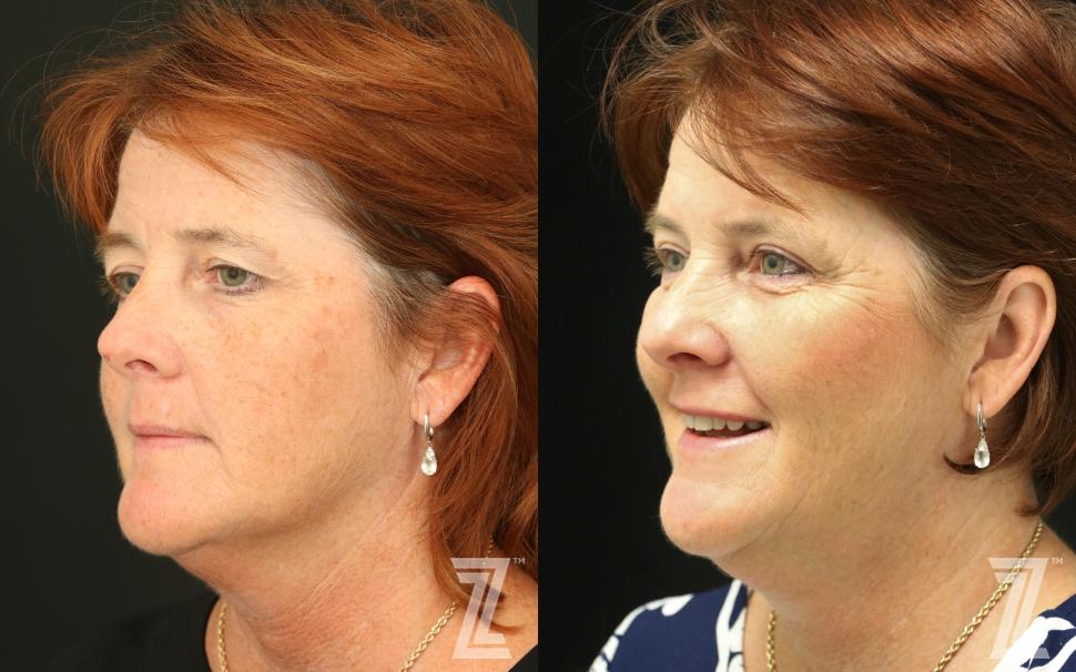 Brow Lift Before & After Photo | Austin, TX | The Piazza Center for Plastic Surgery & Advanced Skin Care