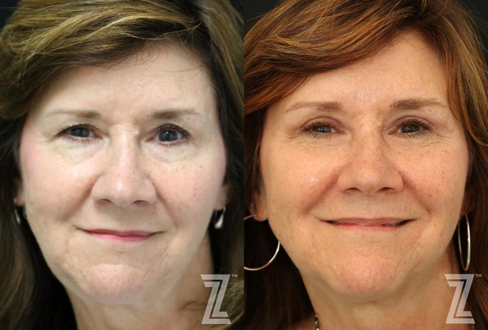 Brow Lift Before & After Photo | Austin, TX | The Piazza Center for Plastic Surgery & Advanced Skin Care
