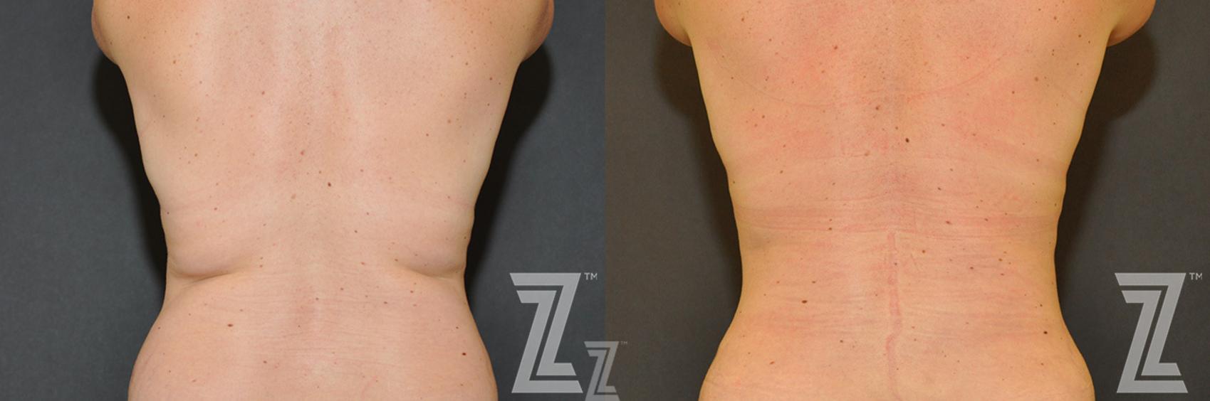 CoolSculpting® Before & After Photo | Austin, TX | The Piazza Center for Plastic Surgery & Advanced Skin Care