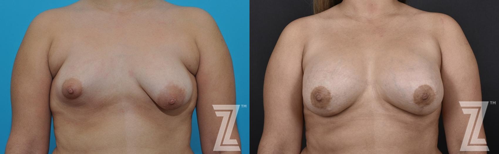 Correction of Breast Asymmetry Before & After Photo | Austin, TX | The Piazza Center for Plastic Surgery & Advanced Skin Care