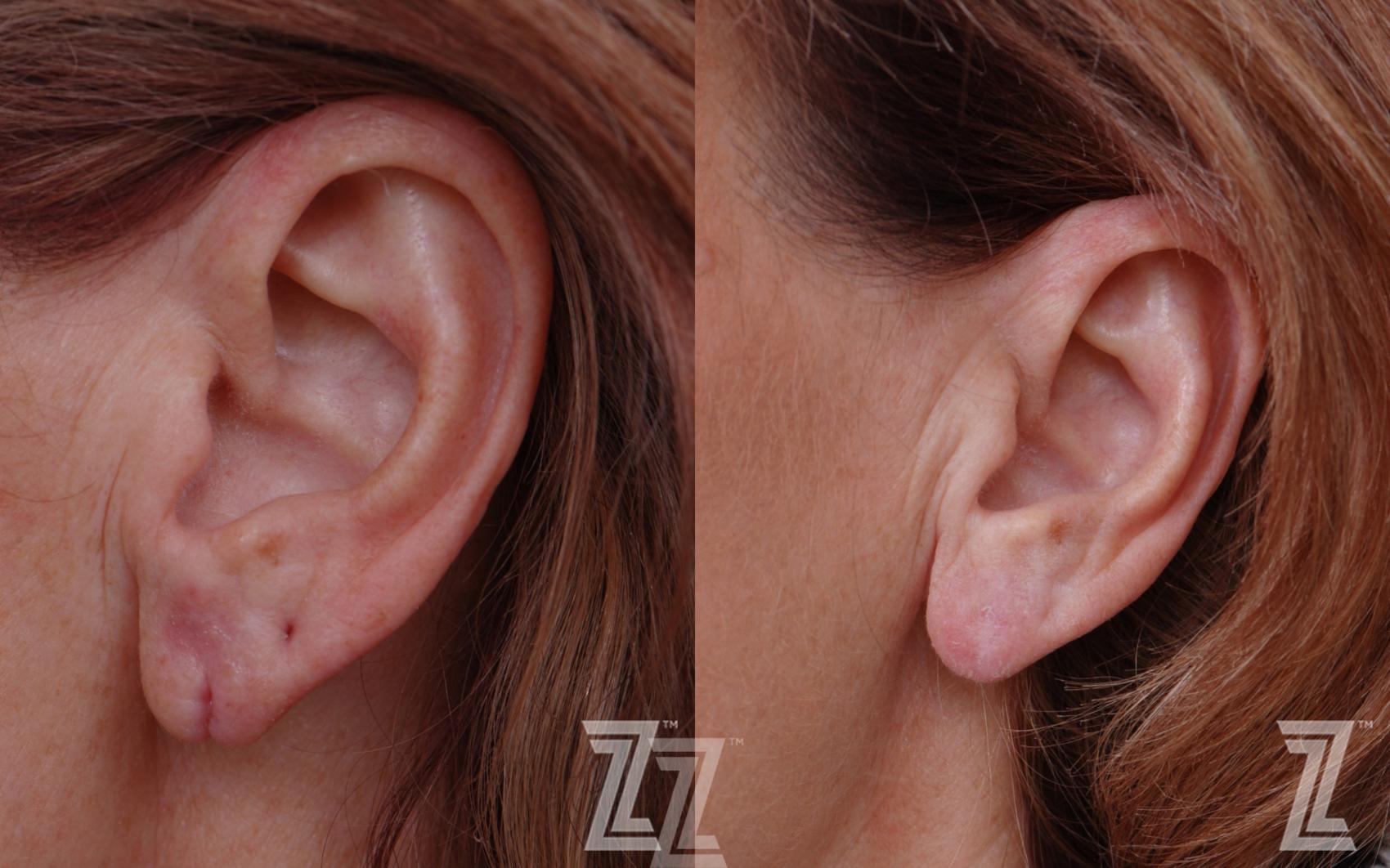Earlobe Repair Before & After Photo | Austin, TX | The Piazza Center for Plastic Surgery & Advanced Skin Care