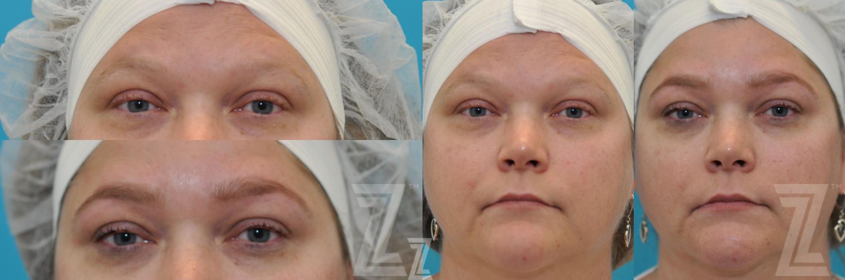 Eyebrow Shaping & Tinting Before & After Photo | Austin, TX | The Piazza Center for Plastic Surgery & Advanced Skin Care