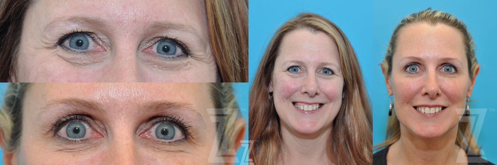 Eyebrow Shaping & Tinting Before & After Photo | Austin, TX | The Piazza Center for Plastic Surgery & Advanced Skin Care