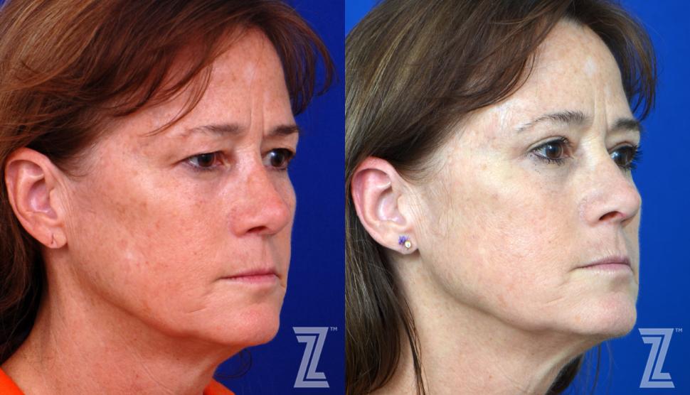 Eyelid Surgery Before & After Photo | Austin, TX | The Piazza Center for Plastic Surgery & Advanced Skin Care