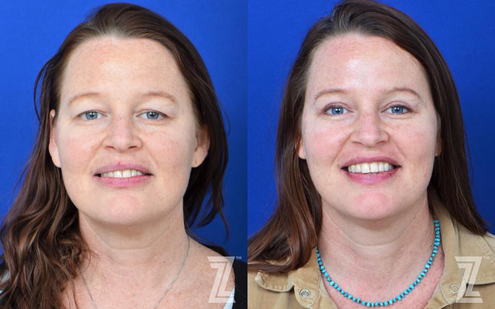 Eyelid Surgery Before & After Photo | Austin, TX | The Piazza Center for Plastic Surgery & Advanced Skin Care