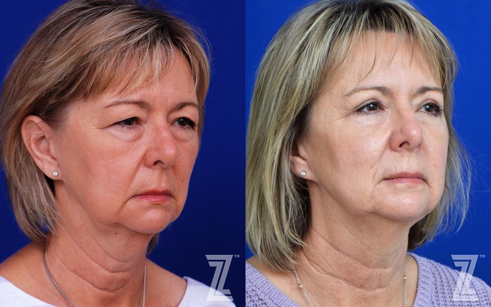 Eyelid Surgery Before & After Photo | Austin, TX | The Piazza Center for Plastic Surgery & Advanced Skin Care