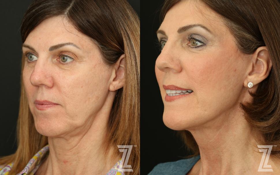 Facelift & Mini Lift Before & After Photo | Austin, TX | The Piazza Center for Plastic Surgery & Advanced Skin Care