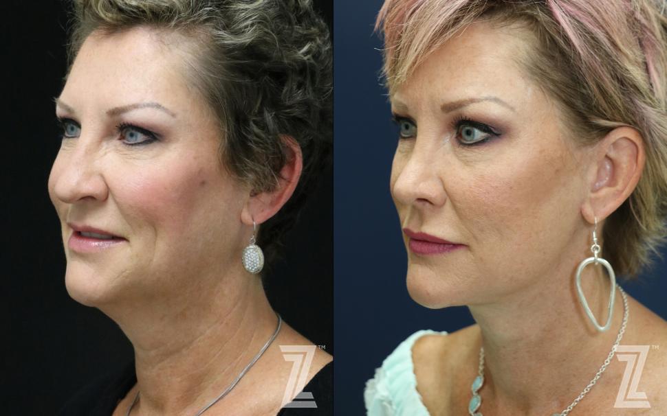 Facelift & Mini Lift Before & After Photo | Austin, TX | The Piazza Center for Plastic Surgery & Advanced Skin Care