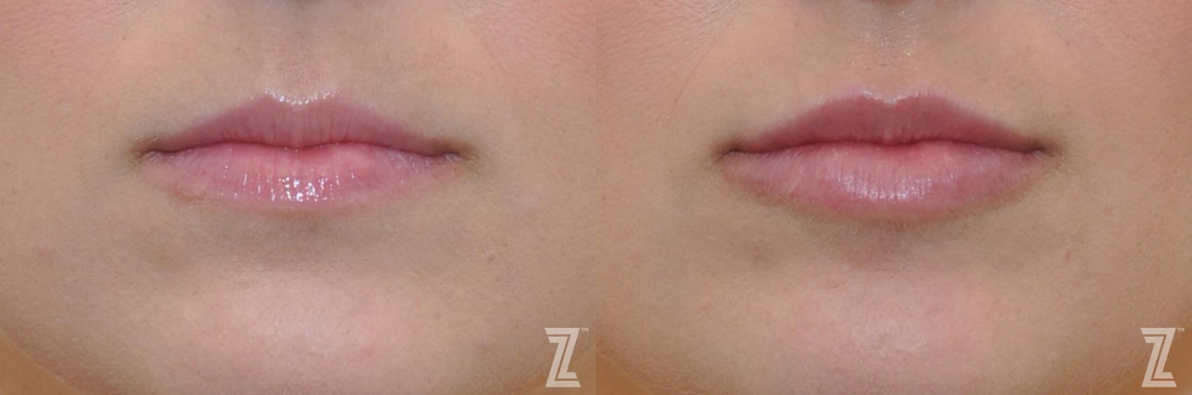 Injectable Fillers Before & After Photo | Austin, TX | The Piazza Center for Plastic Surgery & Advanced Skin Care