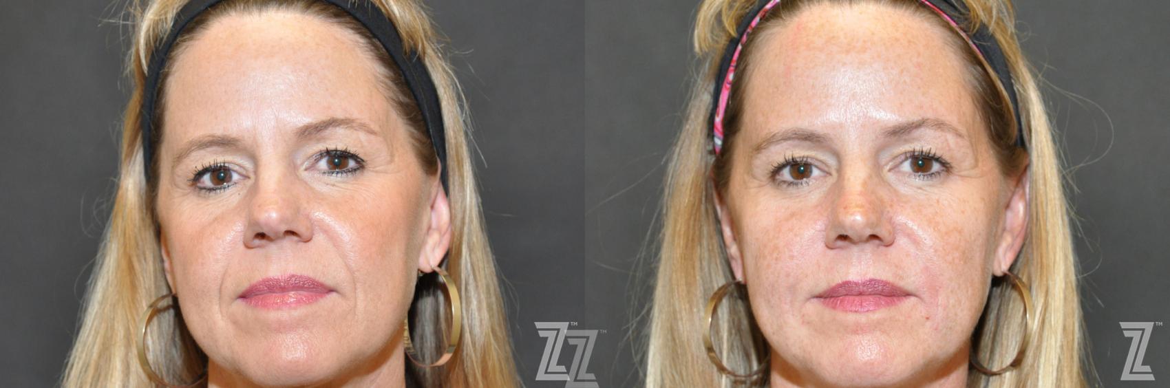 Injectable Fillers Before & After Photo | Austin, TX | The Piazza Center for Plastic Surgery & Advanced Skin Care