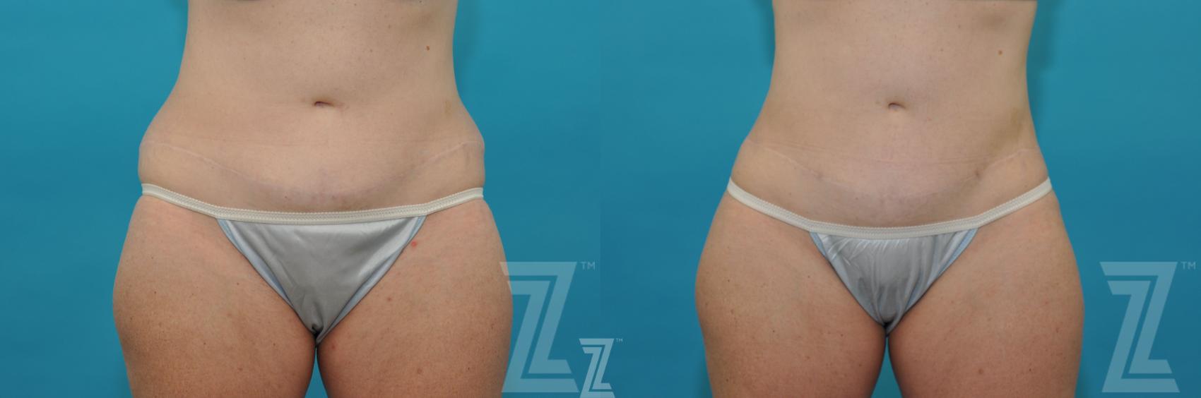 Liposuction Before & After Photo | Austin, TX | The Piazza Center for Plastic Surgery & Advanced Skin Care