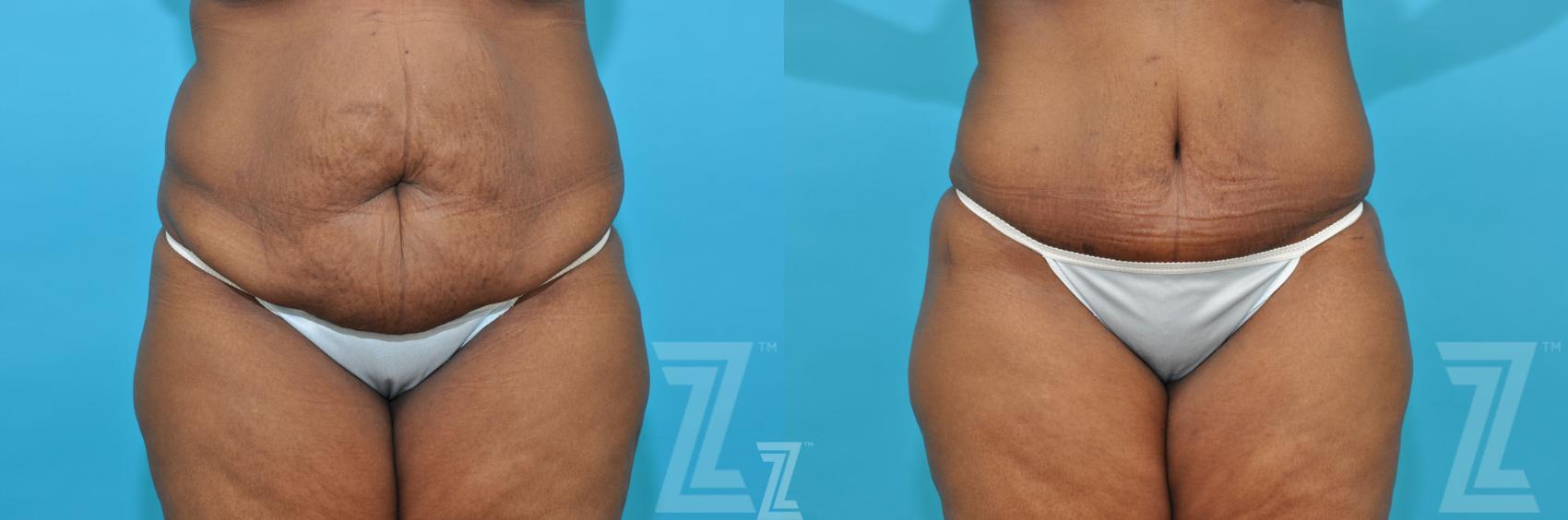 Liposuction Before & After Photo | Austin, TX | The Piazza Center for Plastic Surgery & Advanced Skin Care