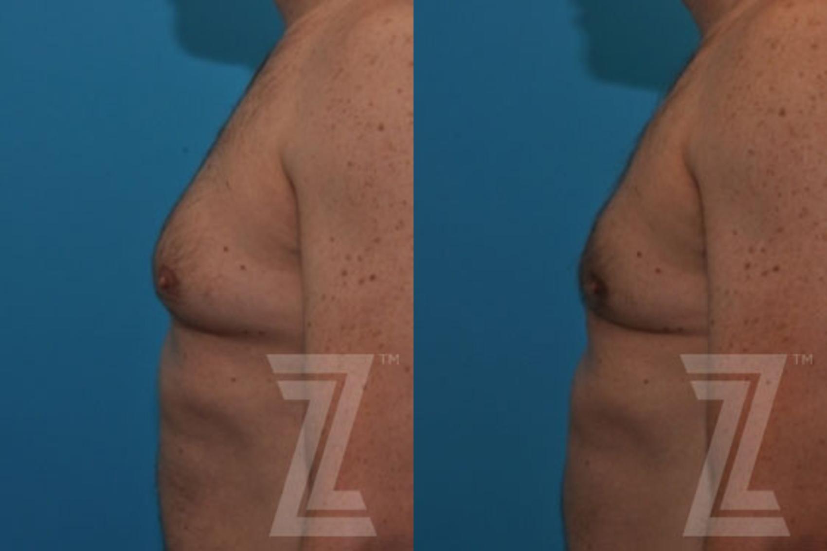 Male Breast Reduction Before & After Photo | Austin, TX | The Piazza Center for Plastic Surgery & Advanced Skin Care