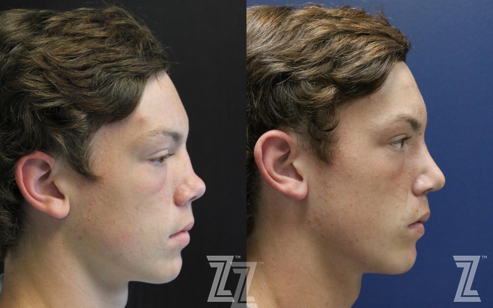 Male Rhinoplasty Before & After Photo | Austin, TX | The Piazza Center for Plastic Surgery & Advanced Skin Care