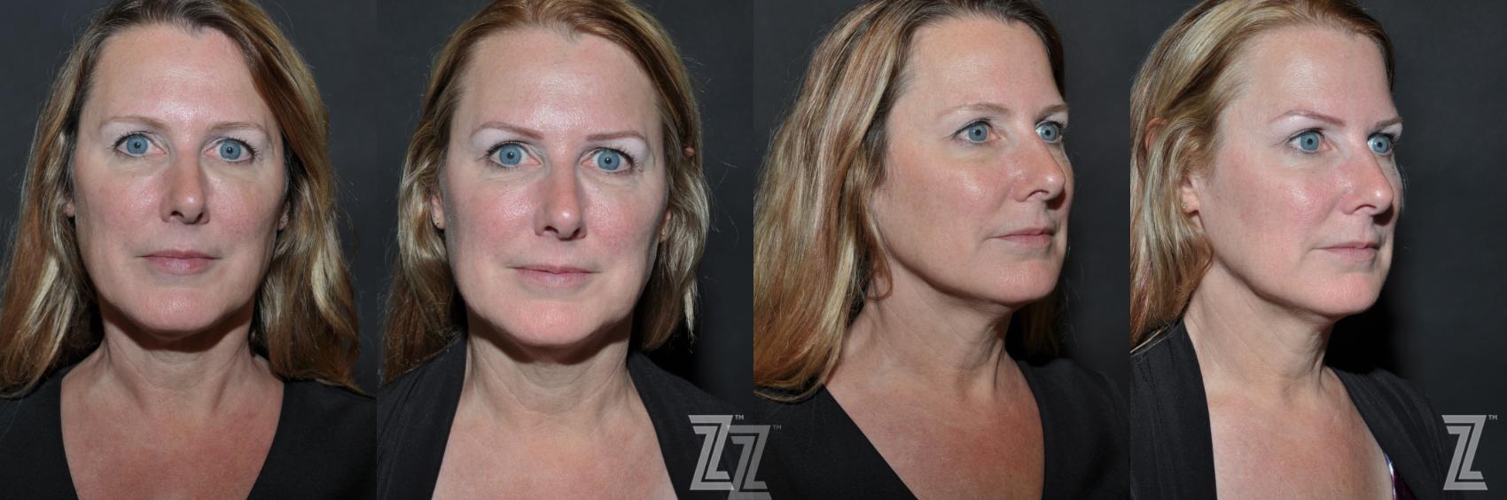 Micropigmentation Before & After Photo | Austin, TX | The Piazza Center for Plastic Surgery & Advanced Skin Care