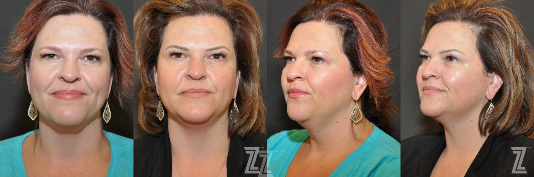 Micropigmentation Before & After Photo | Austin, TX | The Piazza Center for Plastic Surgery & Advanced Skin Care