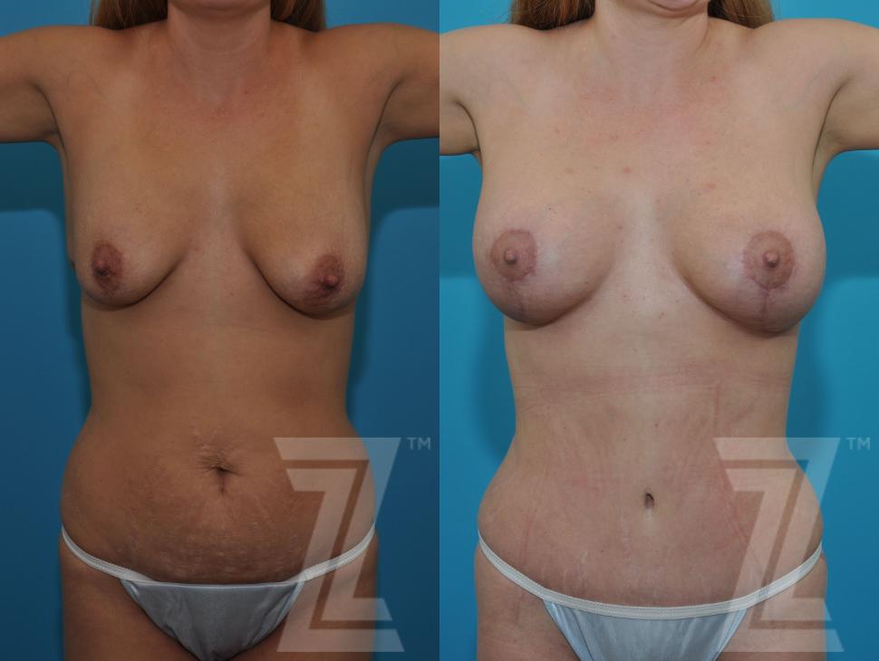 Mommy Makeover Before & After Photo | Austin, TX | The Piazza Center for Plastic Surgery & Advanced Skin Care