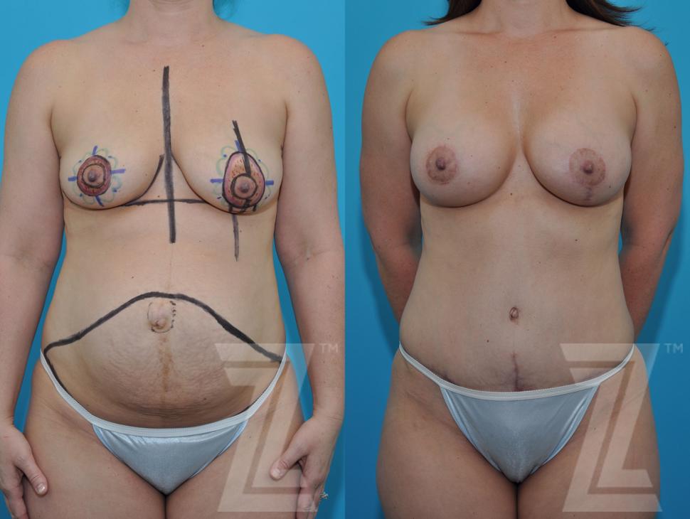 Mommy Makeover Before & After Photo | Austin, TX | The Piazza Center for Plastic Surgery & Advanced Skin Care