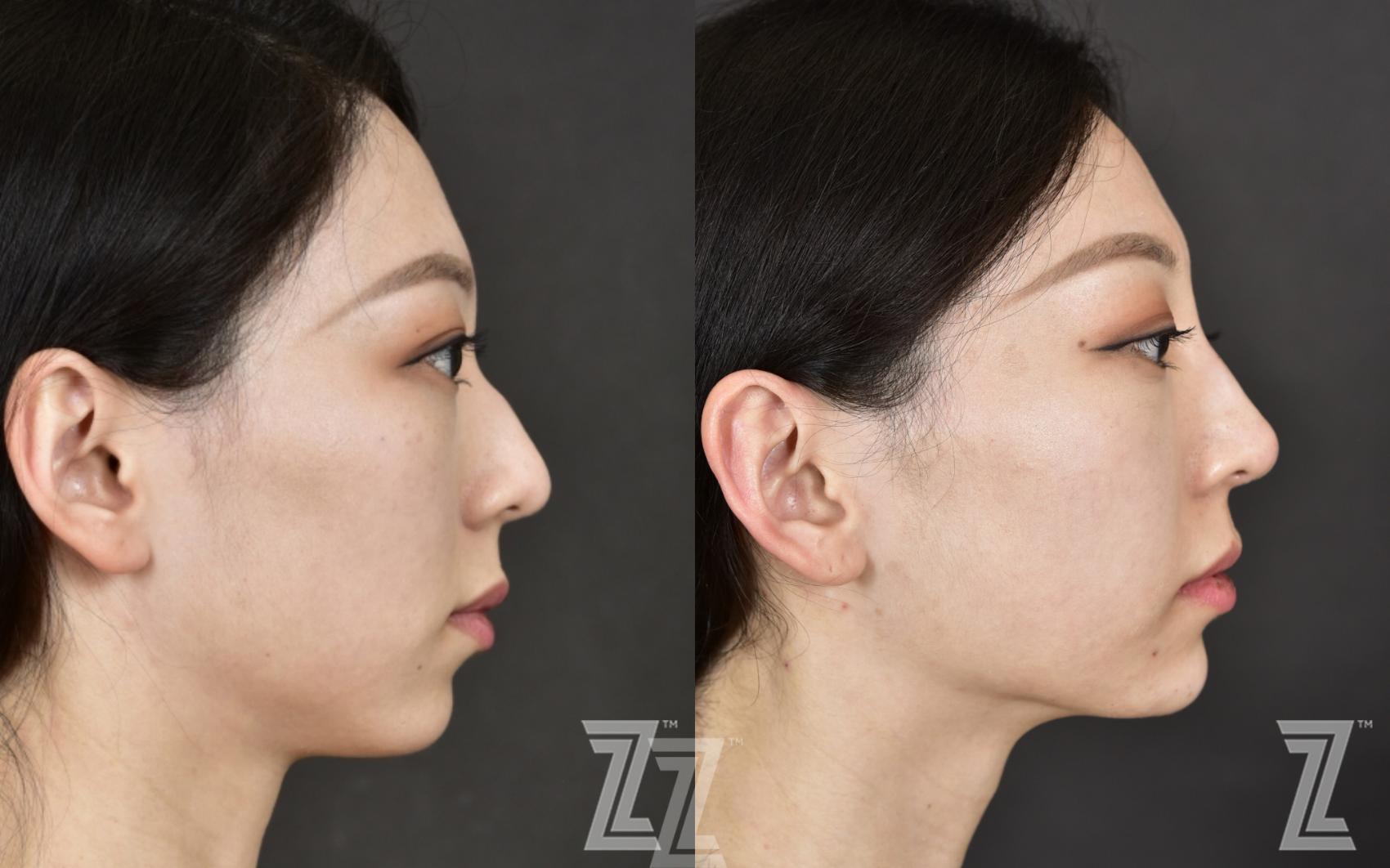 Non-Surgical Rhinoplasty Before & After Photo | Austin, TX | The Piazza Center for Plastic Surgery & Advanced Skin Care