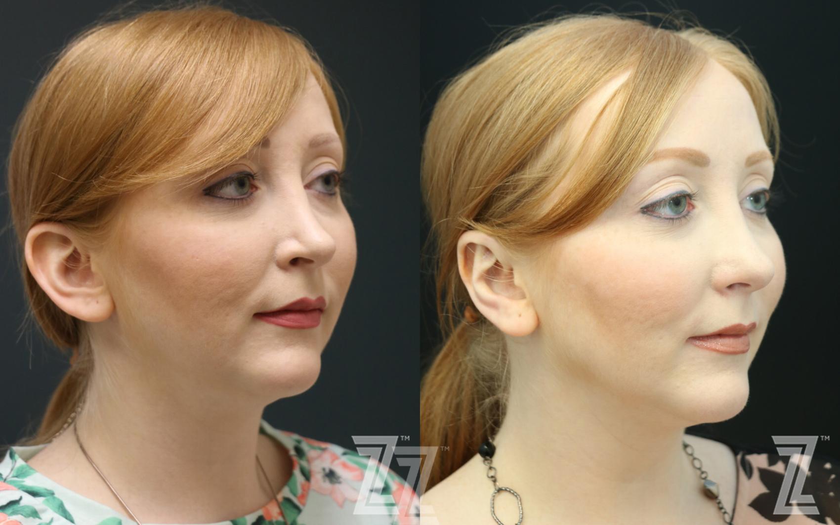 Otoplasty (Ear Surgery) Before & After Photo | Austin, TX | The Piazza Center for Plastic Surgery & Advanced Skin Care