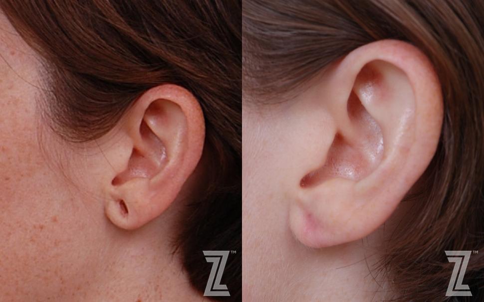 Otoplasty (Ear Surgery) Before & After Photo | Austin, TX | The Piazza Center for Plastic Surgery & Advanced Skin Care