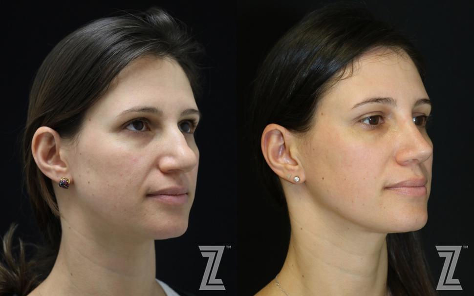 Otoplasty (Ear Surgery) Before & After Photo | Austin, TX | The Piazza Center for Plastic Surgery & Advanced Skin Care