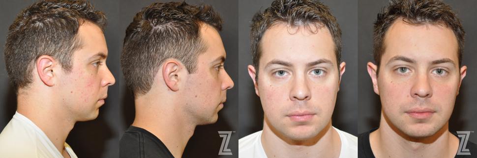 Photofacial Before & After Photo | Austin, TX | The Piazza Center for Plastic Surgery & Advanced Skin Care