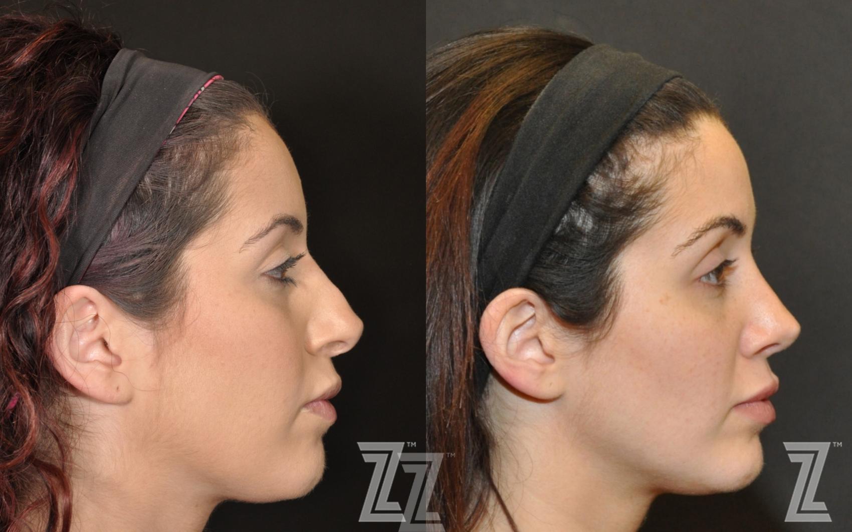 Revision Rhinoplasty Before & After Photo | Austin, TX | The Piazza Center for Plastic Surgery & Advanced Skin Care