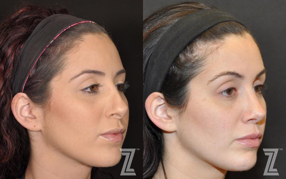 Revision Rhinoplasty Before & After Photo | Austin, TX | The Piazza Center for Plastic Surgery & Advanced Skin Care