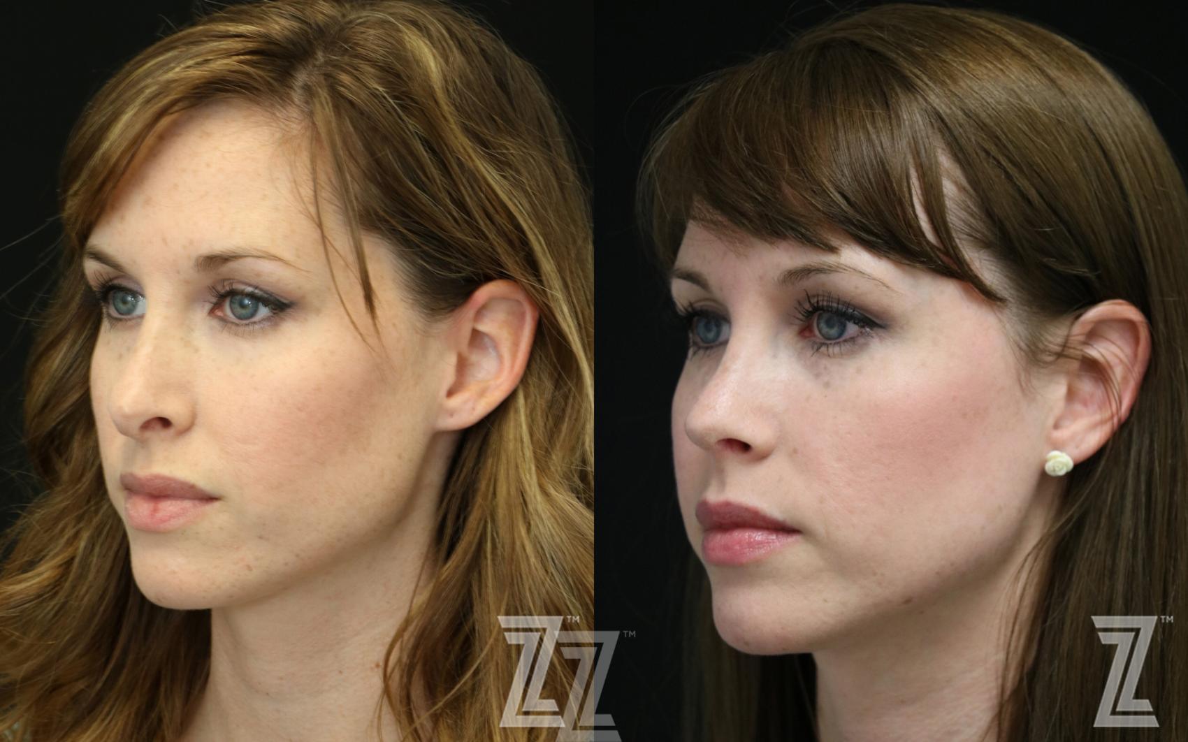 Revision Rhinoplasty Before & After Photo | Austin, TX | The Piazza Center for Plastic Surgery & Advanced Skin Care
