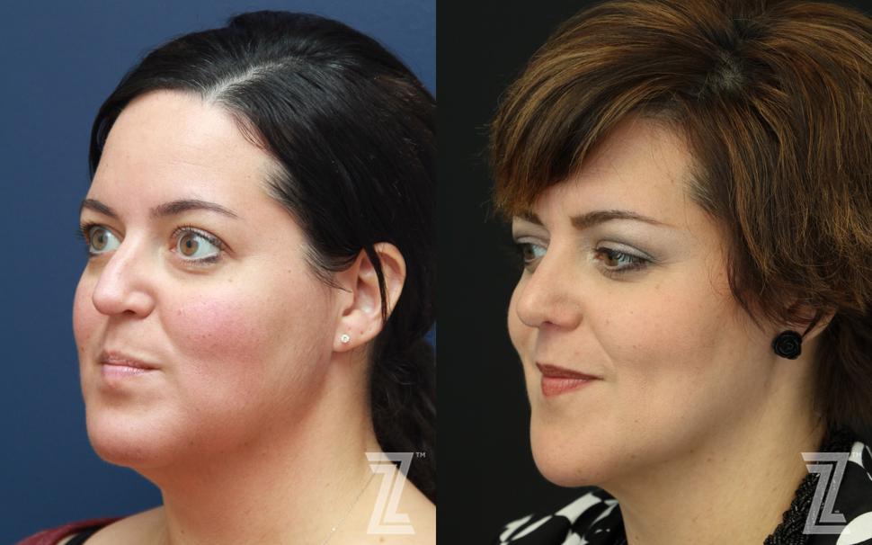 Revision Rhinoplasty Before & After Photo | Austin, TX | The Piazza Center for Plastic Surgery & Advanced Skin Care