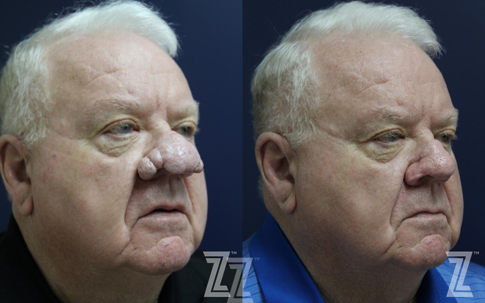 Rhinophyma Before & After Photo | Austin, TX | The Piazza Center for Plastic Surgery & Advanced Skin Care