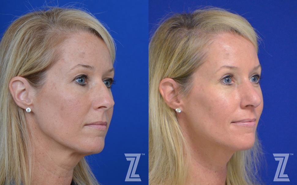 Rhinoplasty Before & After Photo | Austin, TX | The Piazza Center for Plastic Surgery & Advanced Skin Care