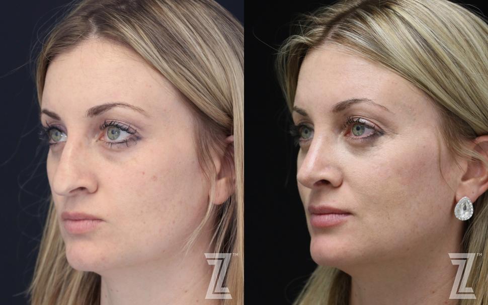 Rhinoplasty Before & After Photo | Austin, TX | The Piazza Center for Plastic Surgery & Advanced Skin Care