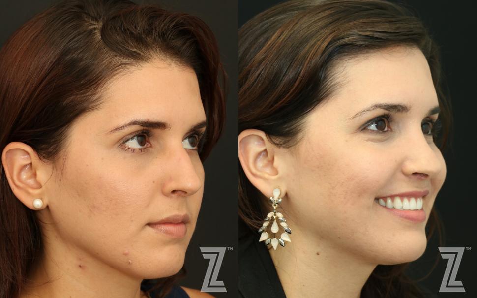 Rhinoplasty Before & After Photo | Austin, TX | The Piazza Center for Plastic Surgery & Advanced Skin Care