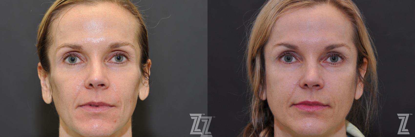 Sculptra® Before & After Photo | Austin, TX | The Piazza Center for Plastic Surgery & Advanced Skin Care