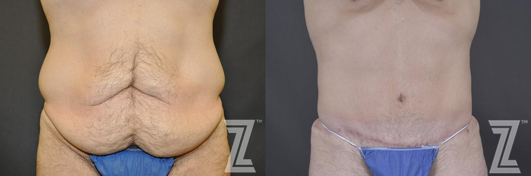 Tummy Tuck Before & After Photo | Austin, TX | The Piazza Center for Plastic Surgery & Advanced Skin Care