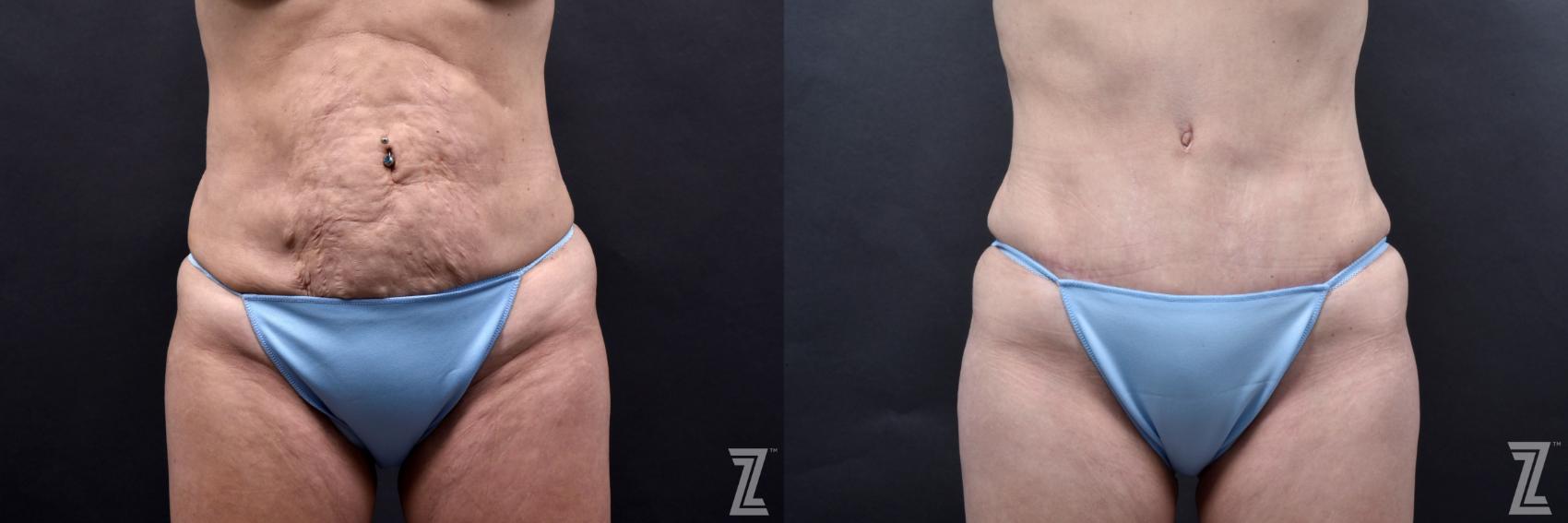 Tummy Tuck Before & After Photo | Austin, TX | The Piazza Center for Plastic Surgery & Advanced Skin Care