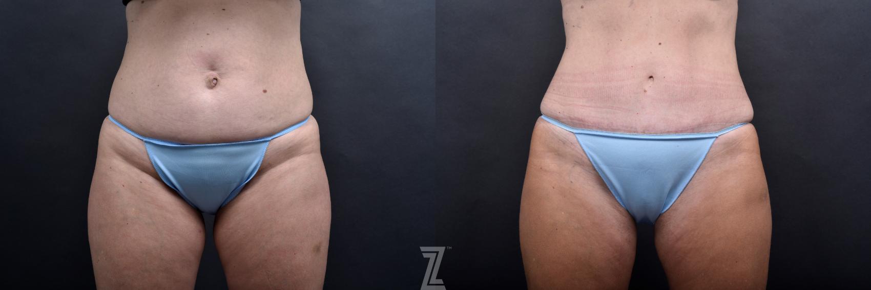Tummy Tuck Before & After Photo | Austin, TX | The Piazza Center for Plastic Surgery & Advanced Skin Care