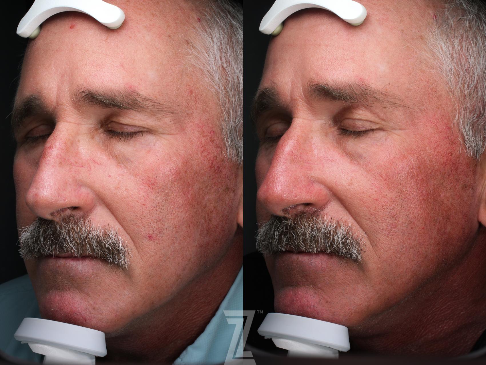 Botox, visia skin analysis, Neurotoxin, Dysport, Before and After, B&A, Tummy Tuck, Breast Aug, Breast Lift, Mastopexy, MMO, Mommy Makeover, Dr. Rocco Piazza, The Piazza Center, Austin, Tx, Halo, BBLlaser